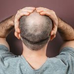 2678936-malepatternbaldness-1722669705-600x450.webp.webp