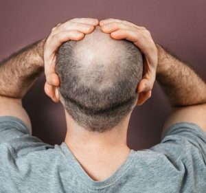 2678936-malepatternbaldness-1722669705-600x450.webp.webp