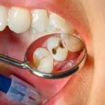 cavity1785344303-0-600x450.webp.webp