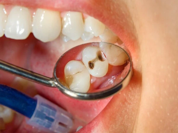 cavity1785344303-0-600x450.webp.webp