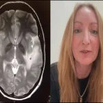 uk-woman-38-parasites-in-brain-from-pig-india1783021755-0-600x450.webp.webp