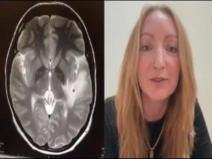 uk-woman-38-parasites-in-brain-from-pig-india1783021755-0-600x450.webp.webp
