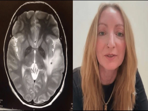 uk-woman-38-parasites-in-brain-from-pig-india1783021755-0-600x450.webp.webp