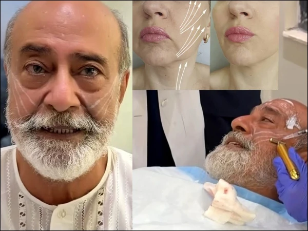 muhammad-ahmed-face-lift1786381080-0-600x450.webp.webp